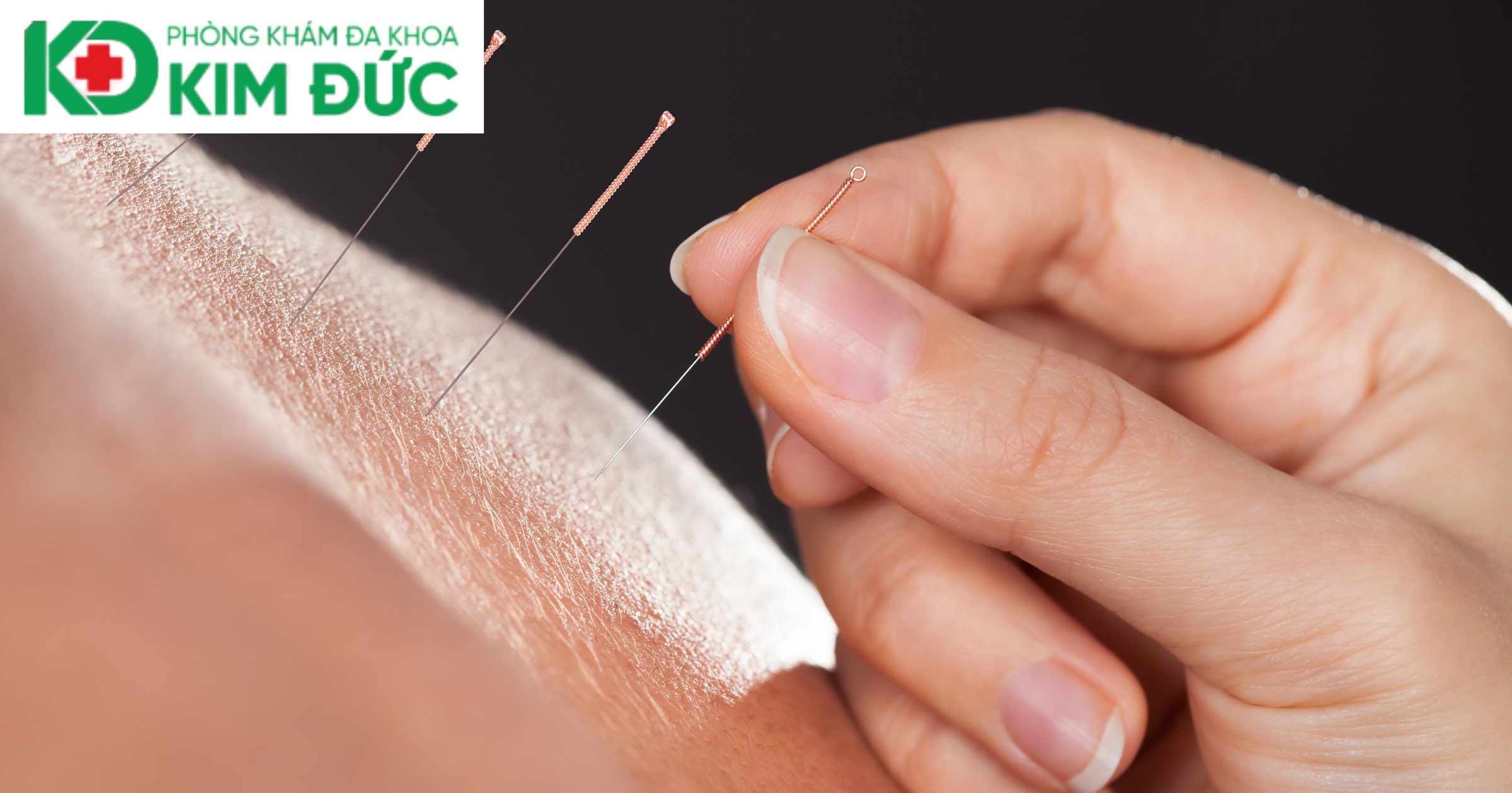 Châm cứu - Phương pháp Đông Y đặc trưng