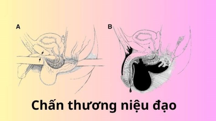 Chấn thương niệu đạo là tình trạng niệu đạo bị tổn thương
