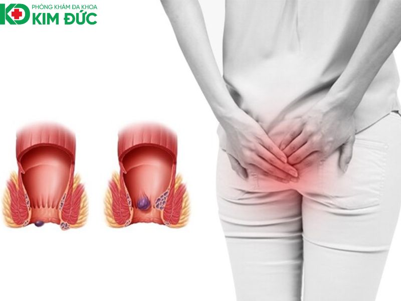 điều trị bệnh trĩ