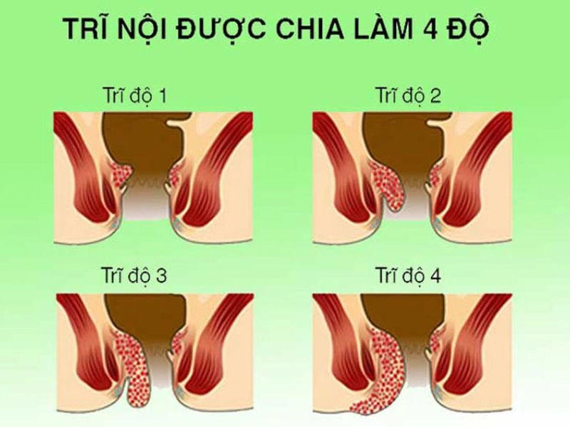 điều trị bệnh trĩ