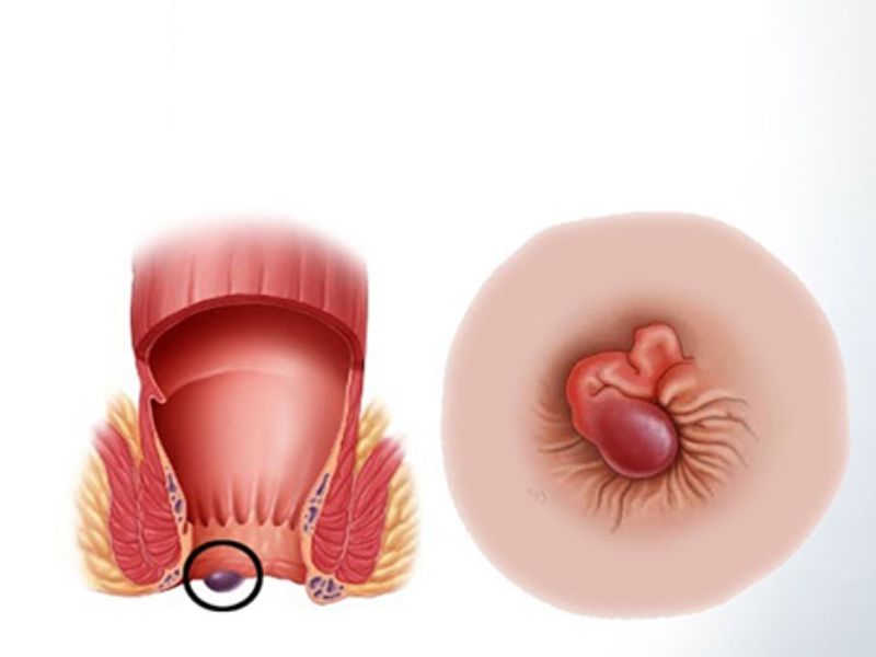 điều trị bệnh trĩ