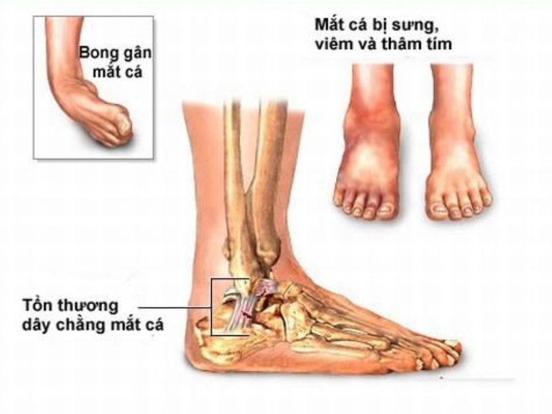 điều trị bong gân