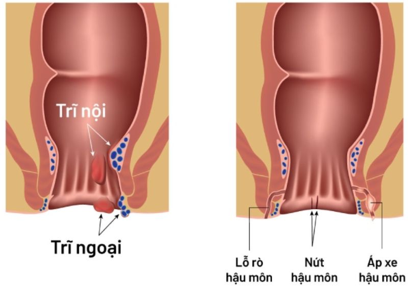 điều trị rò hậu môn