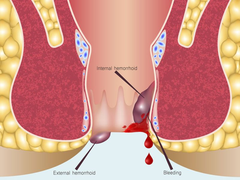 điều trị hậu môn