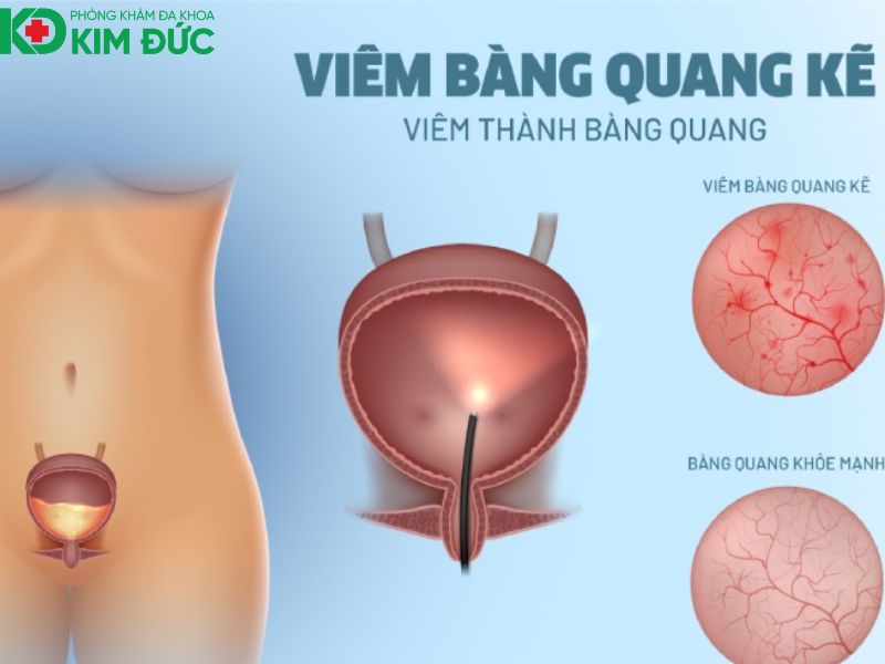 ngoại tiết niệu