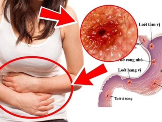 triệu chứng viêm loét dạ dày