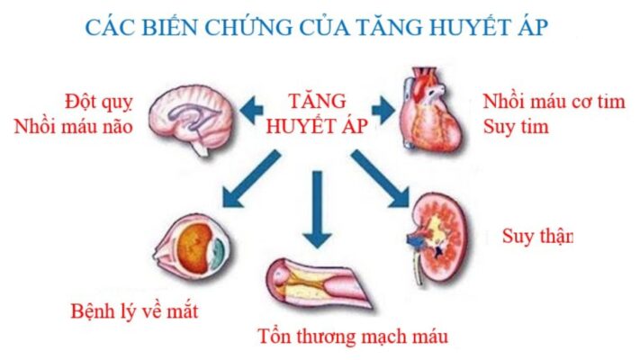huyết áp cao