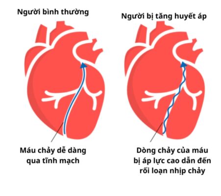 huyết áp cao