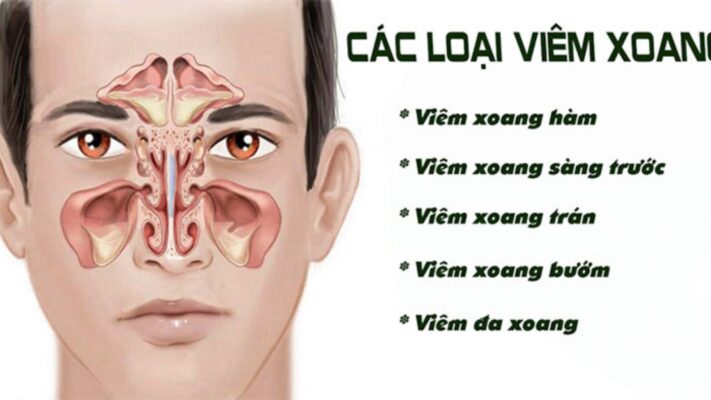 Các loại viêm xoang