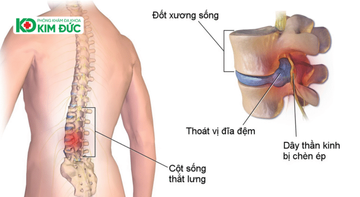 Mô hình giải phẫu cho thấy việc điều trị thoát vị đĩa đệm cần giải phóng chèn ép thần kinh.