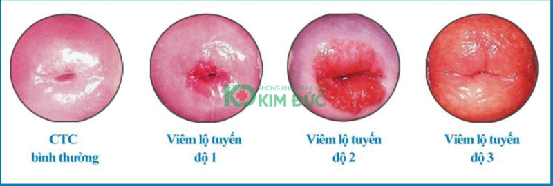 mức độ tổn thương theo từng giai đoạn