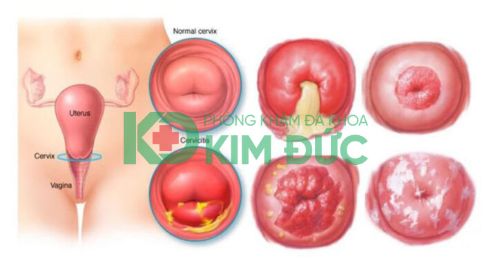 khí hư màu vàng xanh có mùi hôi bất thường
