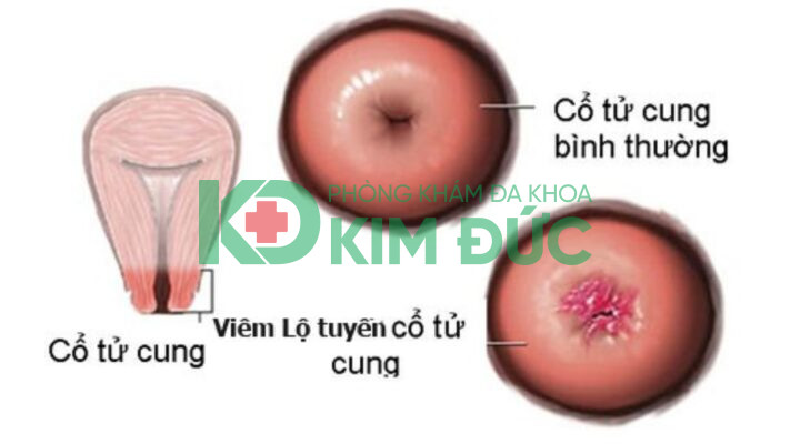 Hình ảnh cấu tạo cổ tử cung và vùng lộ tuyến