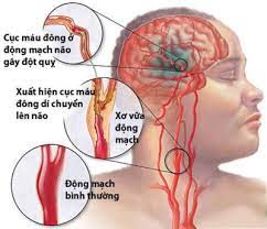 Rối loạn ngôn ngữ và khả năng nuốt