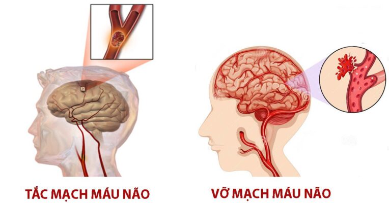 đột quỵ là bệnh gì