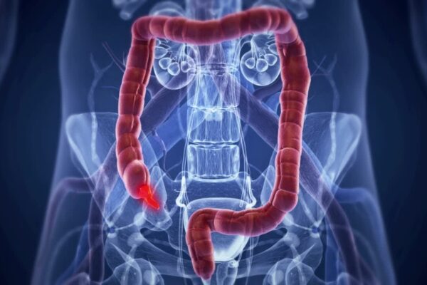 Viêm ruột thừa là gì?