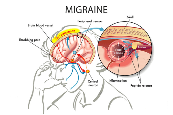 Triệu chứng đau nửa đầu bên phải gây khó chịu.