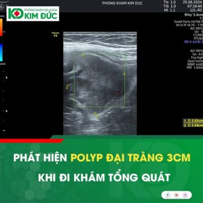 Bác sĩ thực hiện siêu âm bụng tổng quát trong gói khám sức khỏe.