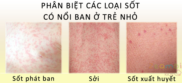 Trẻ em được tiêm vắc-xin phòng ngừa các bệnh có triệu chứng sốt phát ban như sởi, rubella.