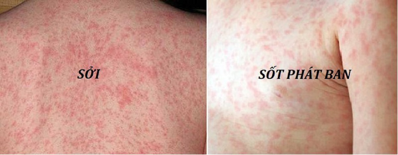 Infographic so sánh trực quan đặc điểm của nốt sốt phát ban, ban sởi và ban sốt xuất huyết.
