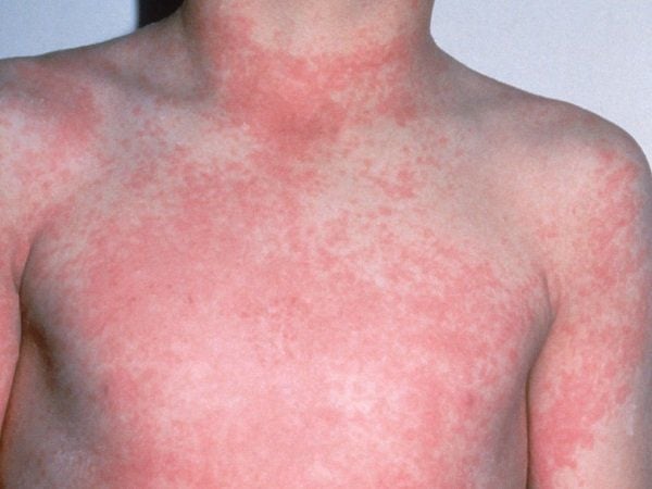 Cận cảnh các nốt sốt phát ban màu hồng nhạt trên làn da của em bé.