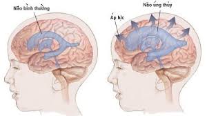 Sơ đồ phân loại các mức độ giãn não thất ở thai nhi: nhẹ, trung bình, và nặng.