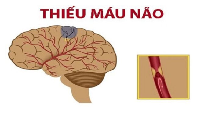 Thiếu máu lên não hay còn gọi là thiểu năng tuần hoàn não, rối loạn tuần hoàn não