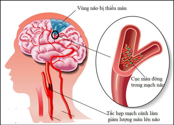 Triệu chứng thiếu máu lên não điển hình bạn cần biết