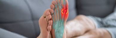 Hình ảnh minh họa vị trí khớp bị viêm do bệnh Gout.