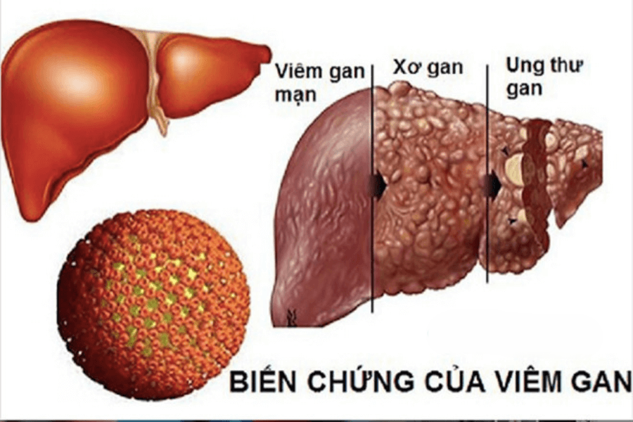 Sơ đồ minh họa các biến chứng nguy hiểm của viêm gan B mạn tính, bao gồm xơ gan và ung thư gan.