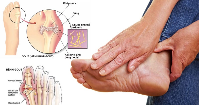 Sơ đồ y khoa minh họa sự hình thành tinh thể axit uric trong khớp ngón chân do bệnh Gout.