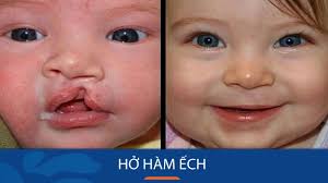 Hình ảnh trẻ bị hở hàm ếch trước và sau khi phẫu thuật thành công.