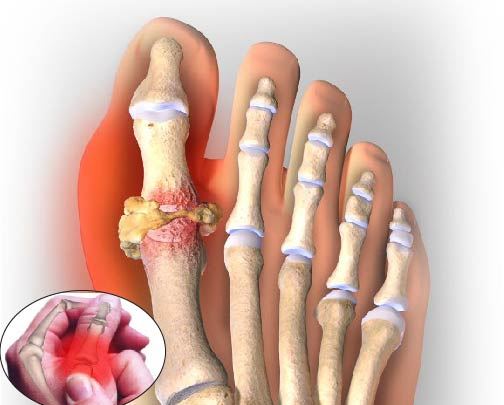 Cận cảnh cơn đau Gout cấp ở khớp ngón chân cái với các tinh thể urat tích tụ.
