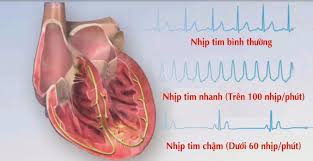 Hình ảnh so sánh nhịp tim bình thường, nhịp nhanh và nhịp chậm.
