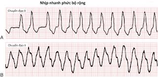 Điện tâm đồ nhịp nhanh phức bộ rộng.