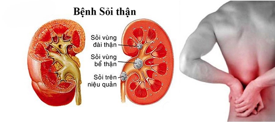 Hình ảnh minh họa sỏi thận trong đài và bể thận.