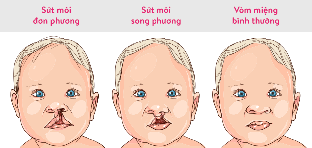 Phân biệt các dạng sứt môi đơn phương và song phương.