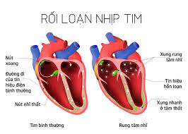 Minh họa rối loạn nhịp tim