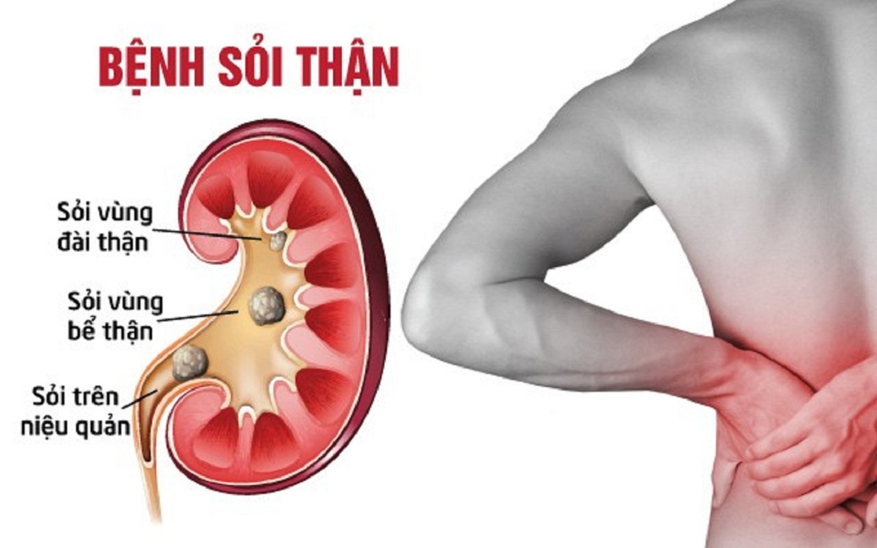 Người đàn ông bị đau hông lưng, một triệu chứng điển hình của sỏi thận.