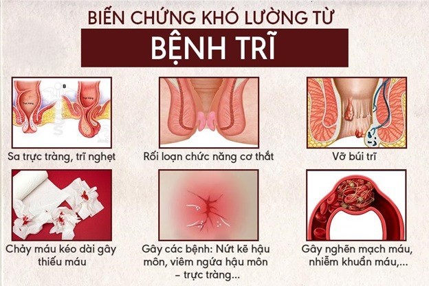 Bác sĩ chuyên khoa tư vấn cho bệnh nhân về các biến chứng của bệnh trĩ nội.