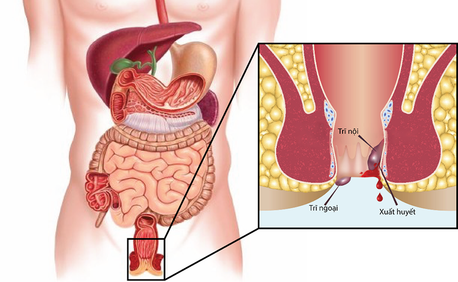 Sơ đồ các nguyên nhân chính gây ra bệnh trĩ nội như táo bón, mang thai, ngồi lâu.