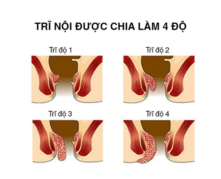 Hình ảnh minh họa 4 cấp độ của bệnh trĩ nội, từ độ 1 đến độ 4.