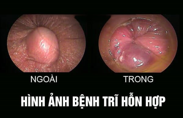 Bác sĩ tiến hành thăm khám và nội soi hậu môn để chẩn đoán chính xác bệnh trĩ nội.