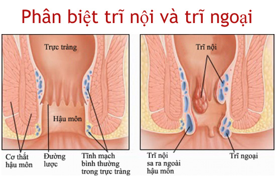 Sơ đồ phân biệt vị trí của trĩ nội và trĩ ngoại so với đường lược.