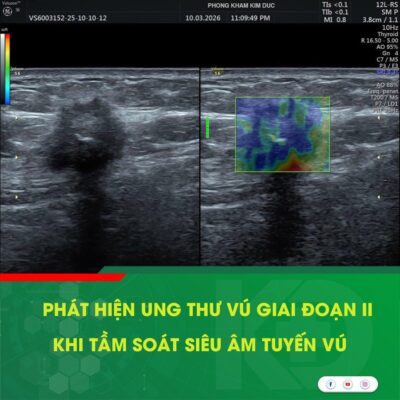 Nên tầm soát ung thư vú