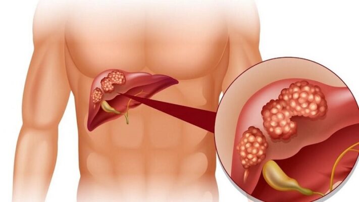 Vôi hóa gan xảy ra khi các tế bào gan bị tổn thương bởi tác nhân gây hại
