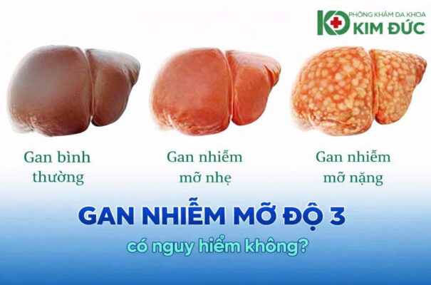 gan nhiễm mỡ độ 3