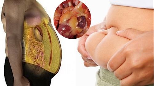 gan nhiễm mỡ độ 3