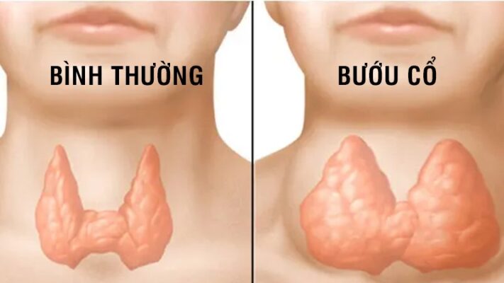 Bướu cổ là gì