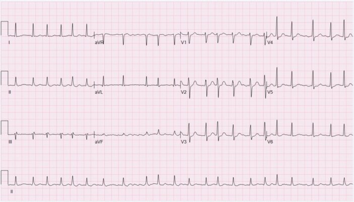 Hình ảnh điện tâm đồ ECG